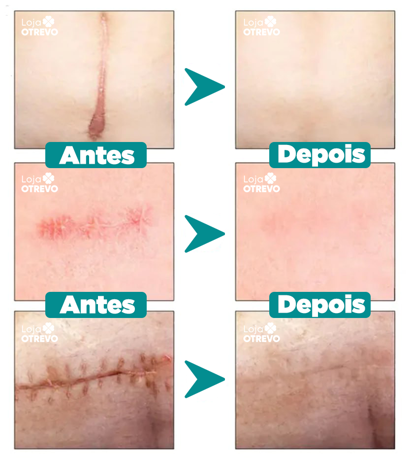 Spray Removedor Rápido de Cicatriz - ScarMax®