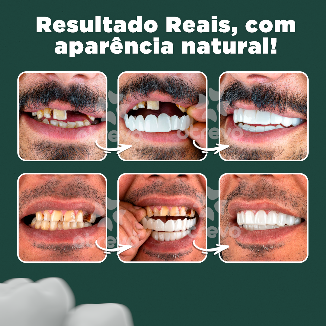 Nature Smile® - Facetas Dentárias Removíveis *G (COMPRE 1 PAR E LEVE OUTRO)